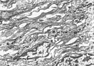 M,15y. | neurinoma n. optici M,15y. | neurinoma n. optici